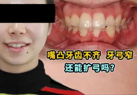 下载视频: 【90后嘴凸女生】嘴凸牙弓窄！成年人到底还能不能扩弓？