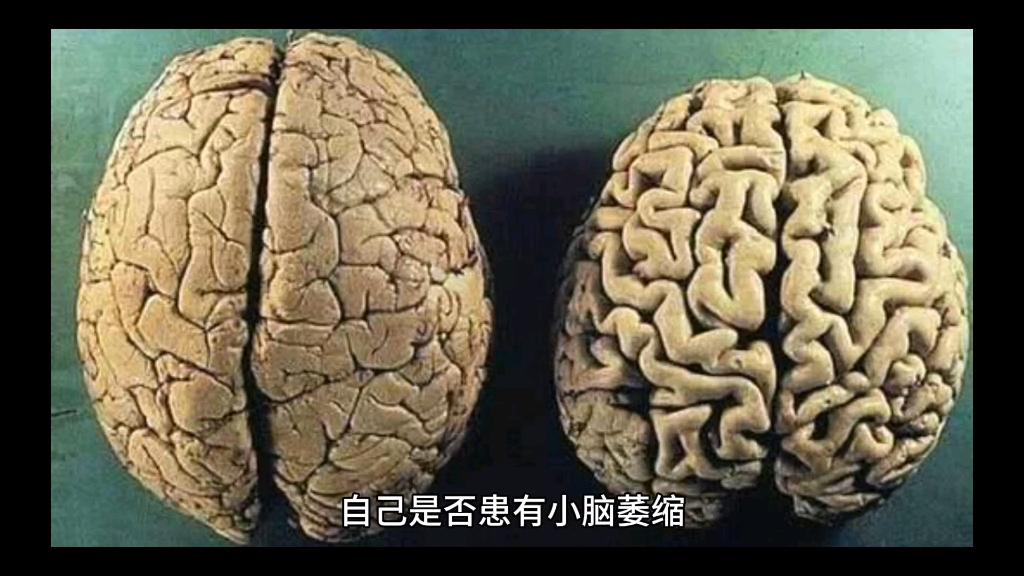 小脑萎缩自我检查小方法