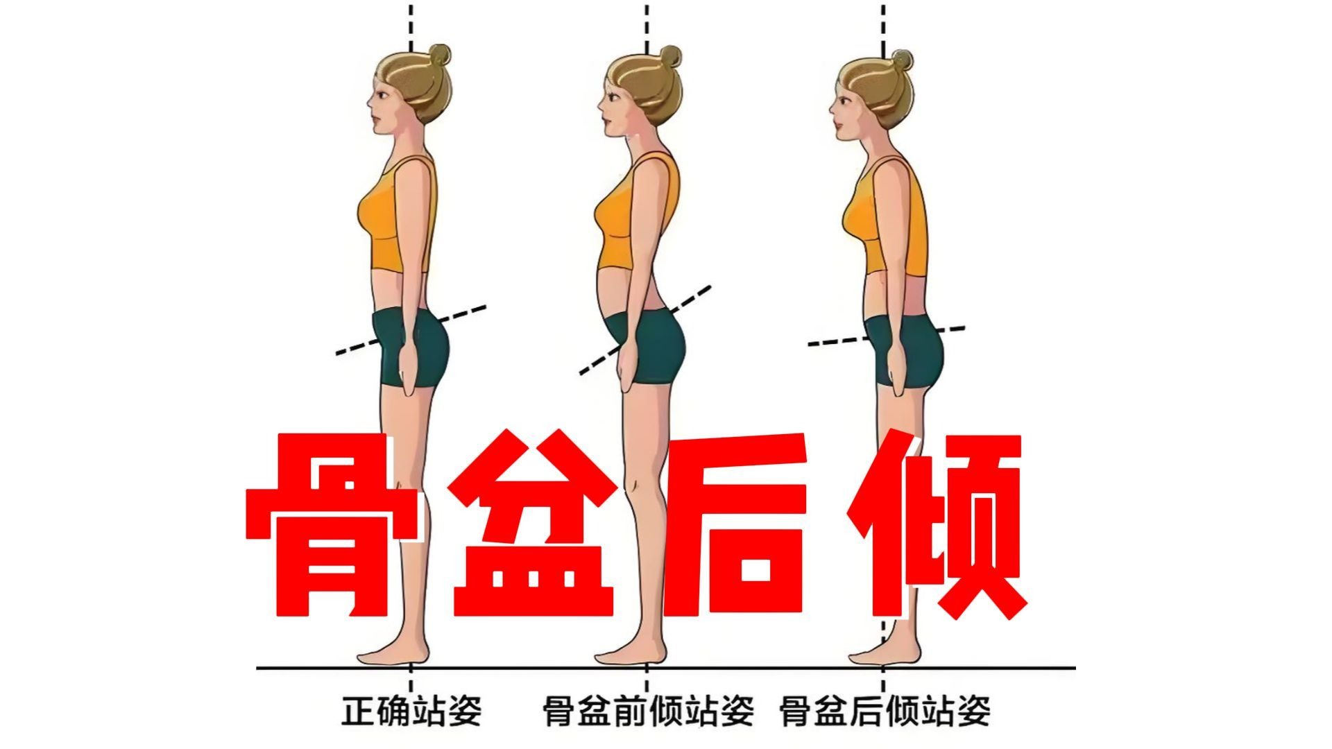 骨盆后倾