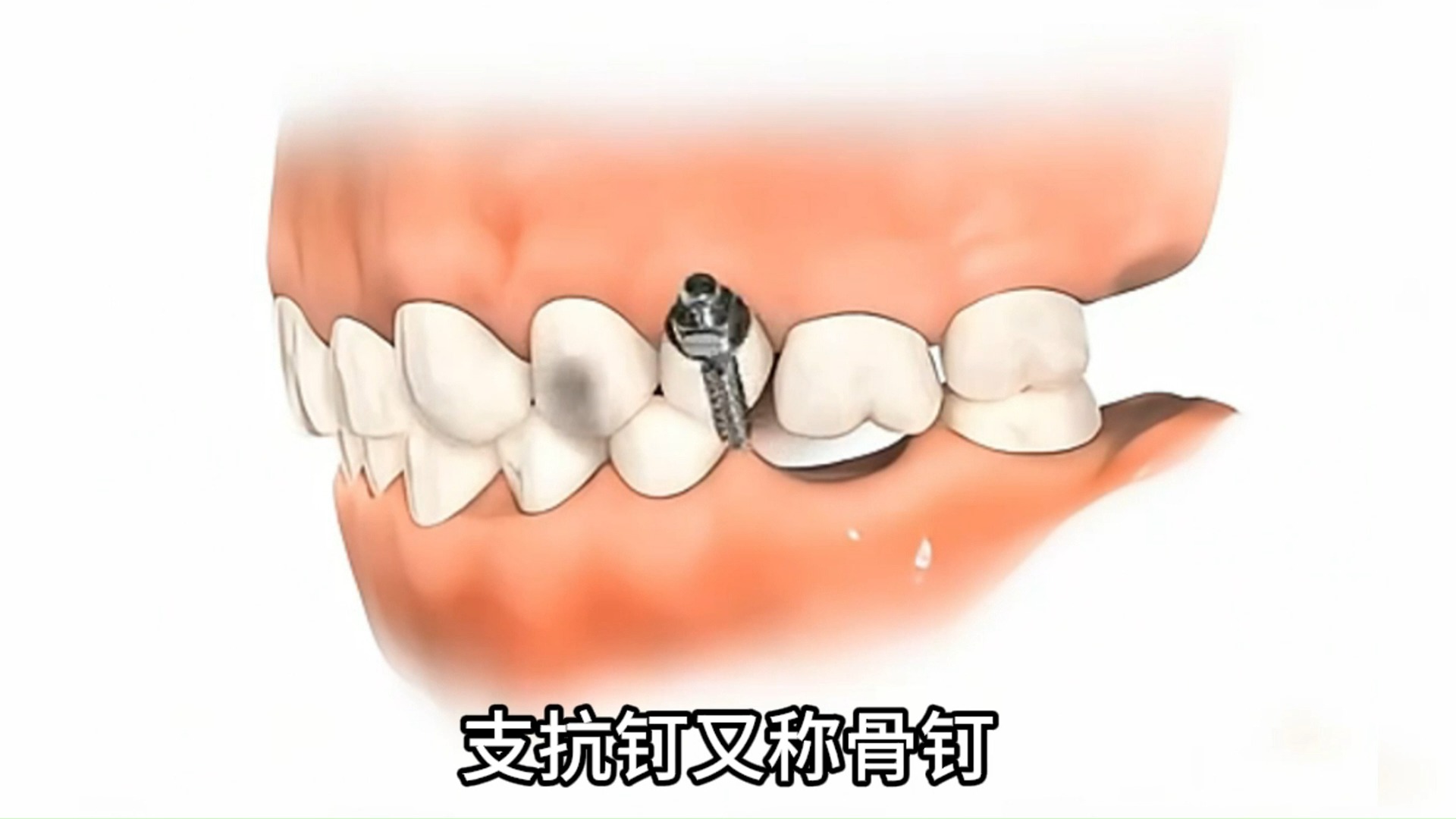 北京牙齿矫正|支抗钉正畸神辅助哔哩哔哩bilibili