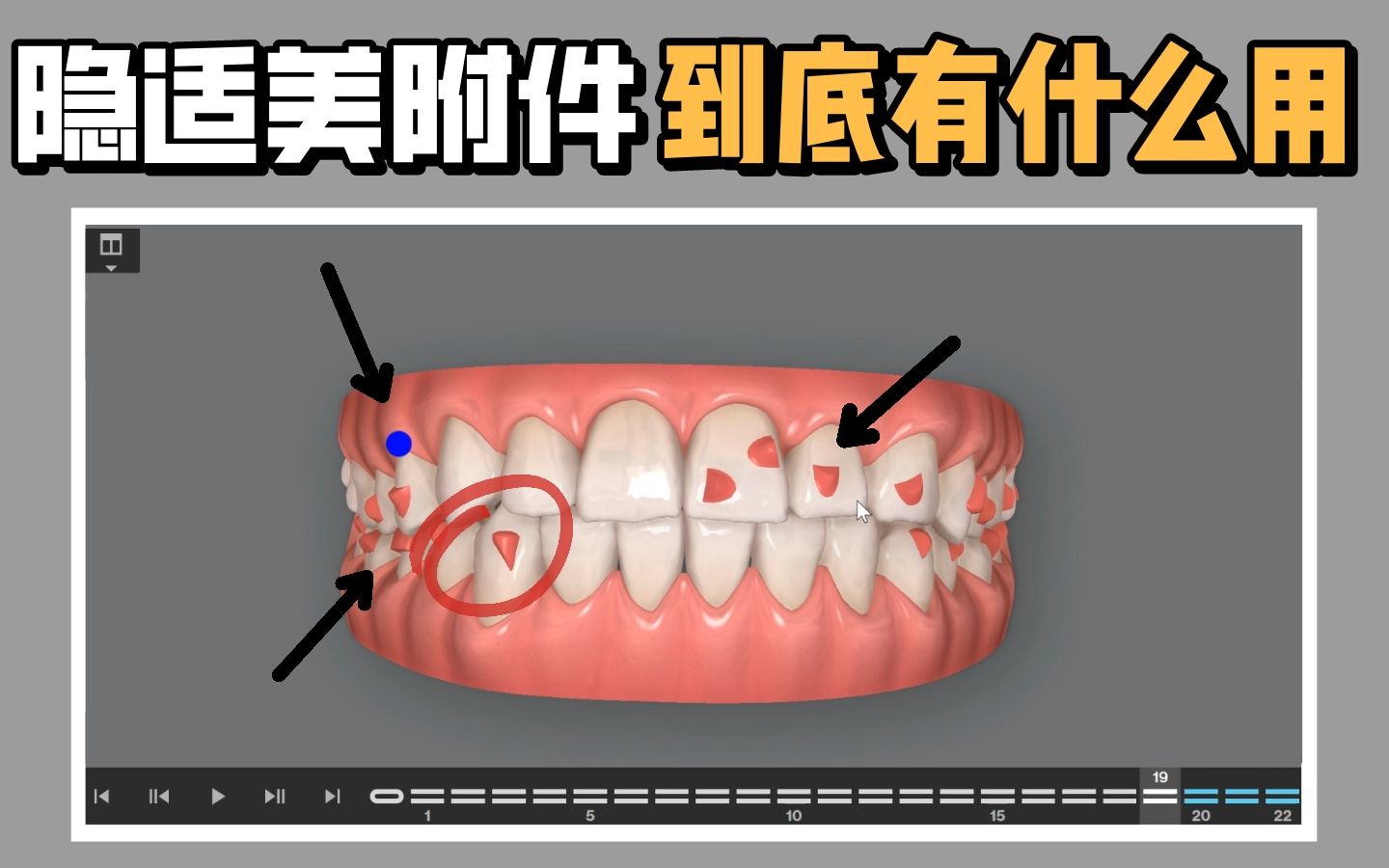 纯干货|隐适美牙套上粘贴那么多附件,到底有什么作用?不粘会出什么问题?哔哩哔哩bilibili