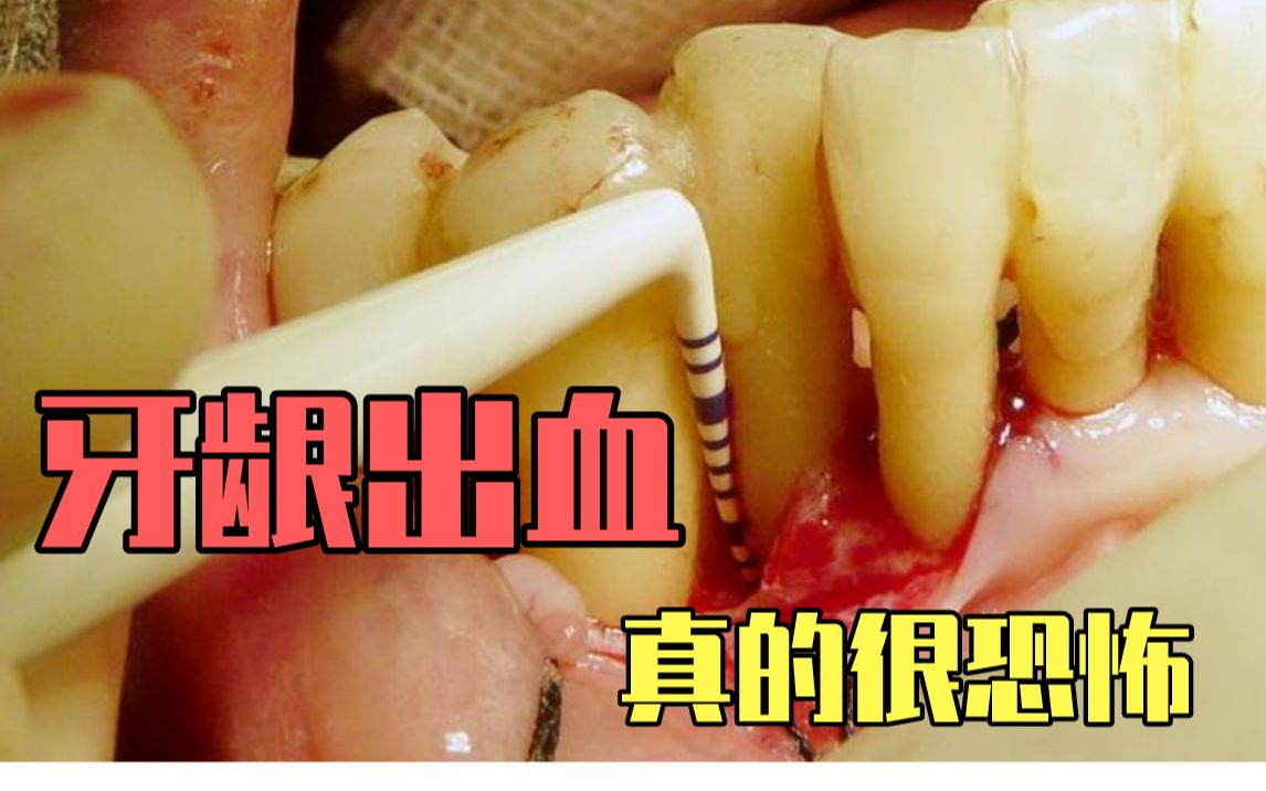 如果你经常牙龈出血,请务必看看!避免牙齿全掉完!