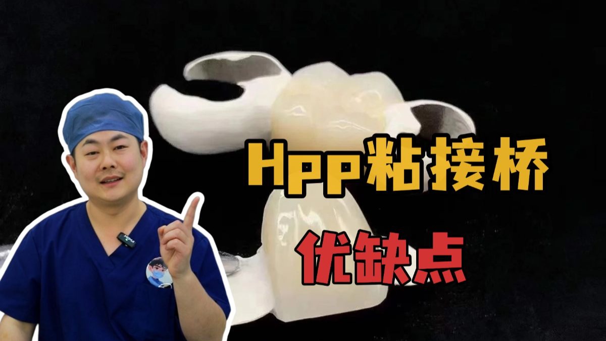 Hpp粘结桥的优缺点有哪些❓