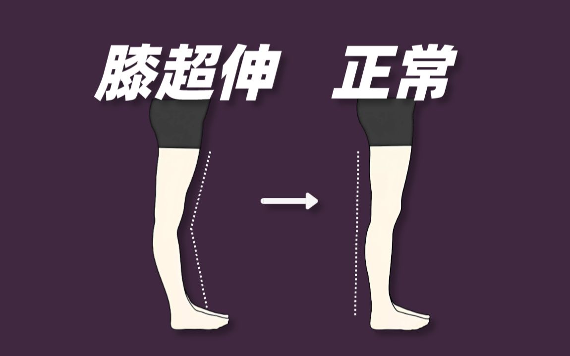 【3min拯救膝超伸】膝关节只是受害者,膝超伸的真正原因是