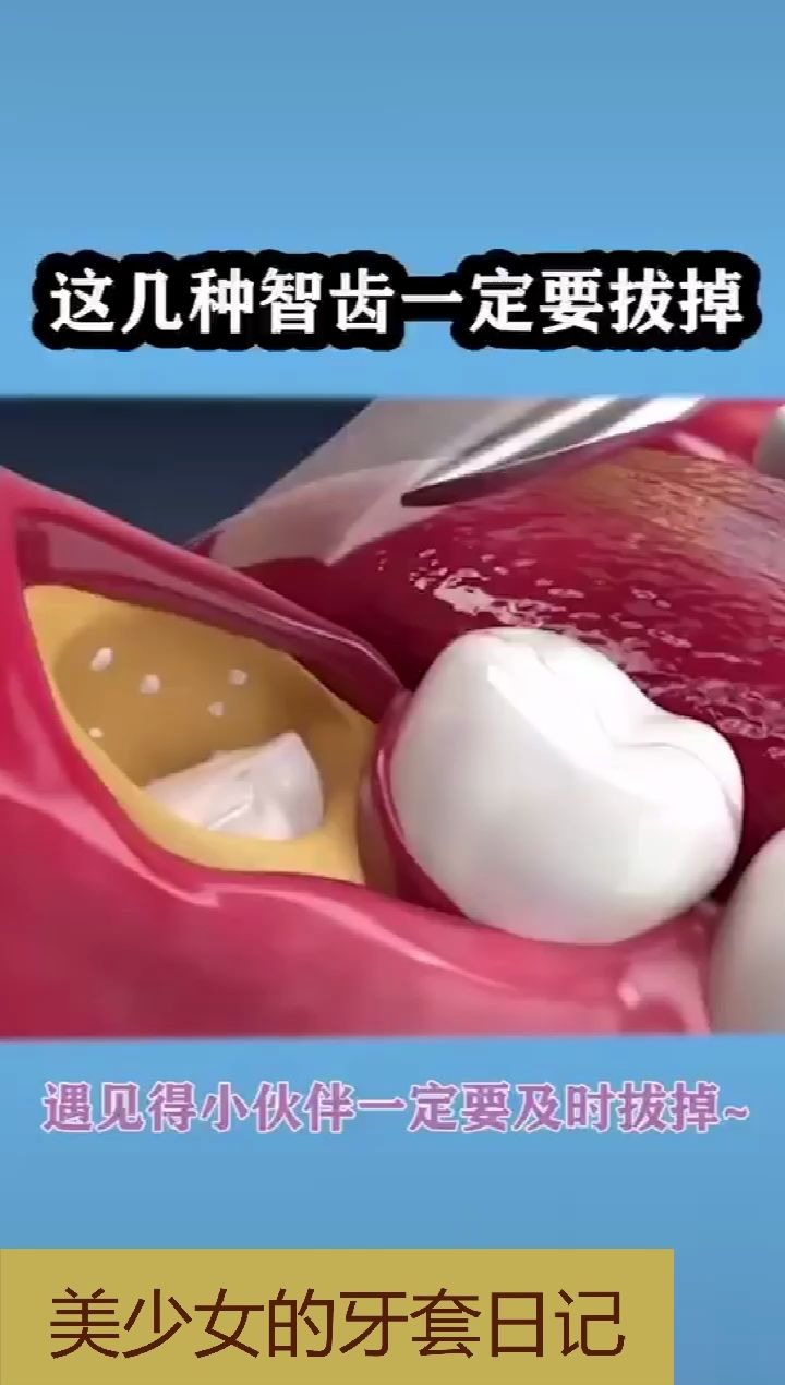 有哪几种智齿一定是要拔掉的