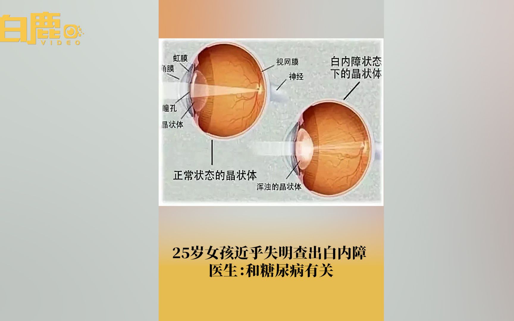 25岁女孩患糖尿病致白内障险些失明