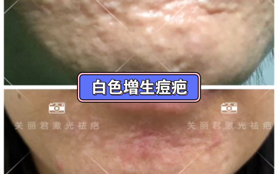 下巴长痘痘反复挤压形成的白色增生痘疤.脸上留下的凹陷痘坑.