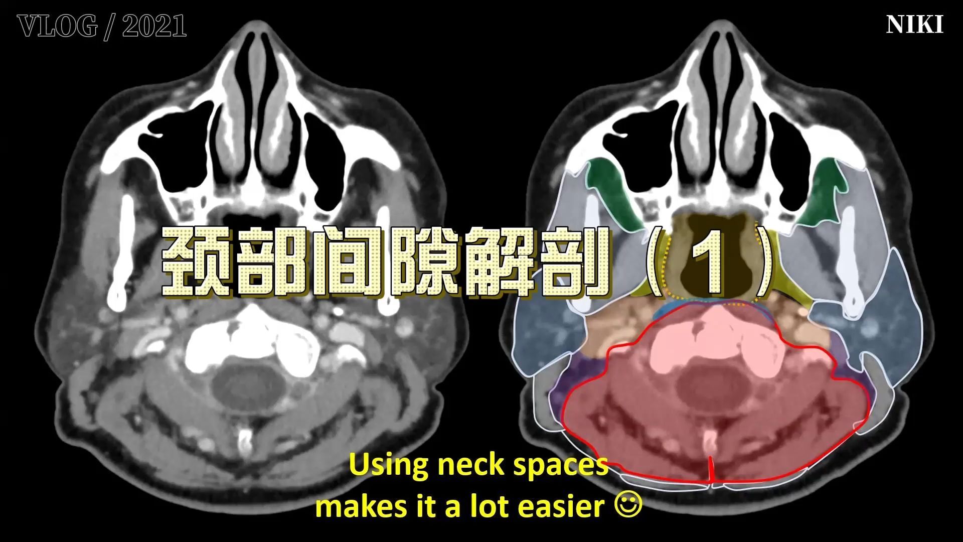 颈部间隙解剖结构（1）