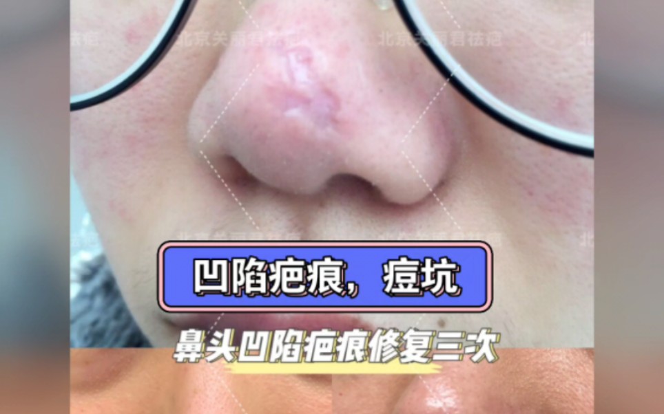 凹陷疤痕,痘坑,挤痘痘留下的.痘印