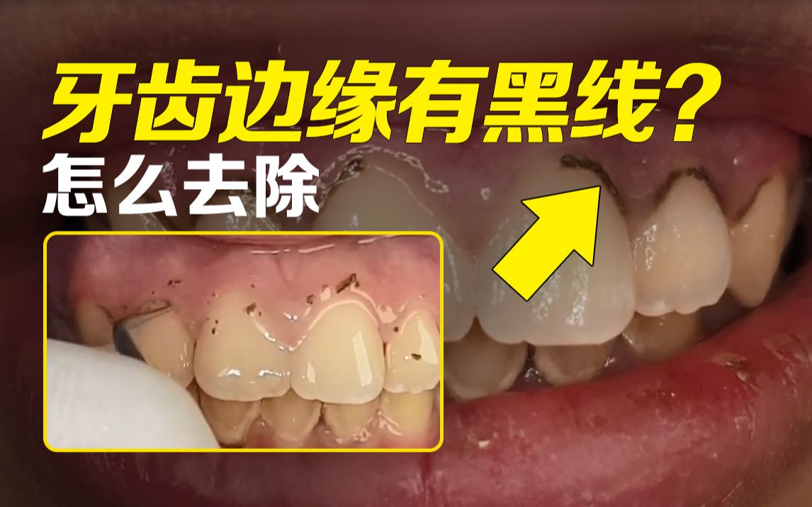 [图]牙龈边上硬硬的黑线怎么回事？如何清理掉