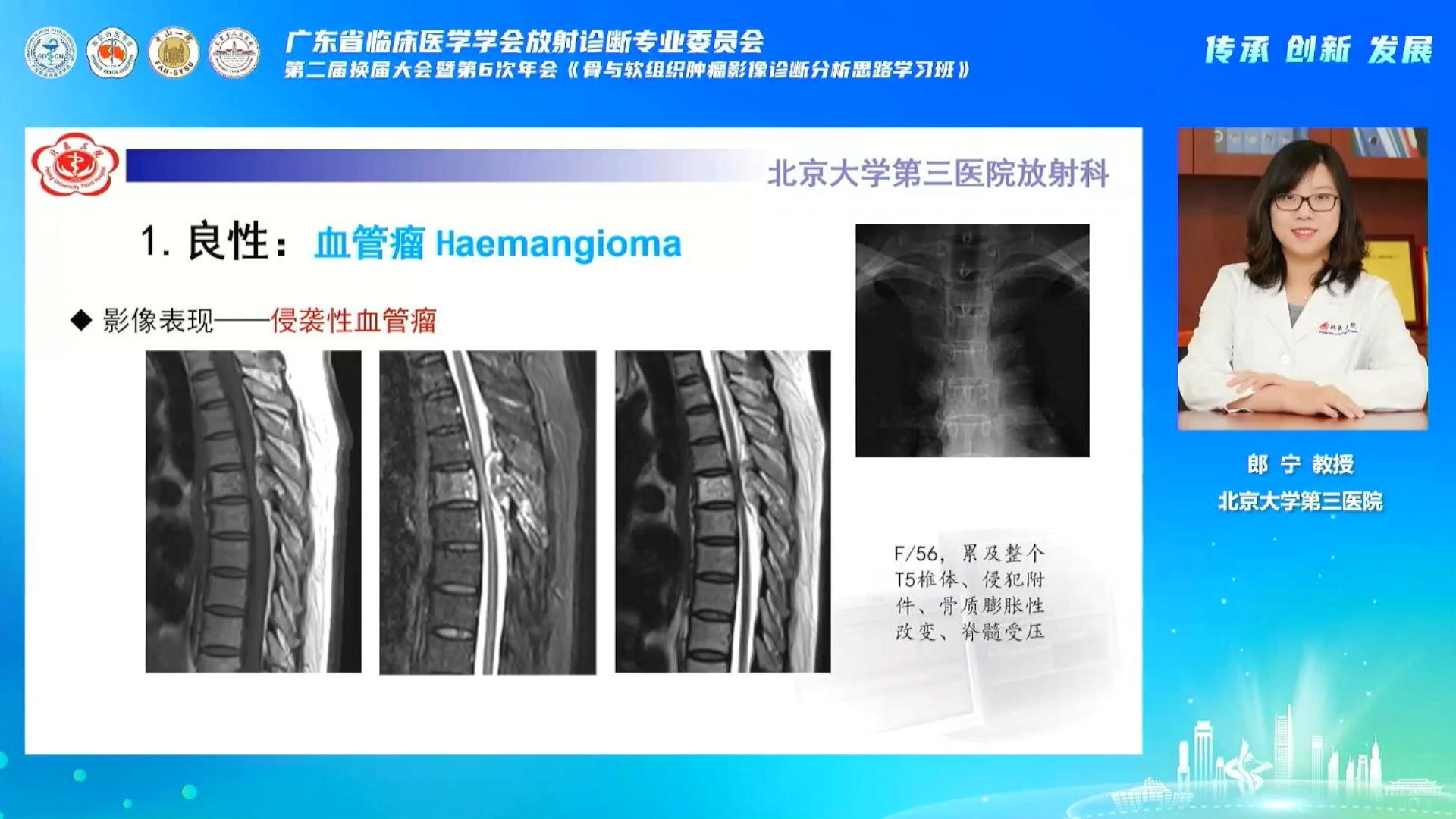 脊柱骨血管肿瘤的影像学表现郎宁哔哩哔哩bilibili