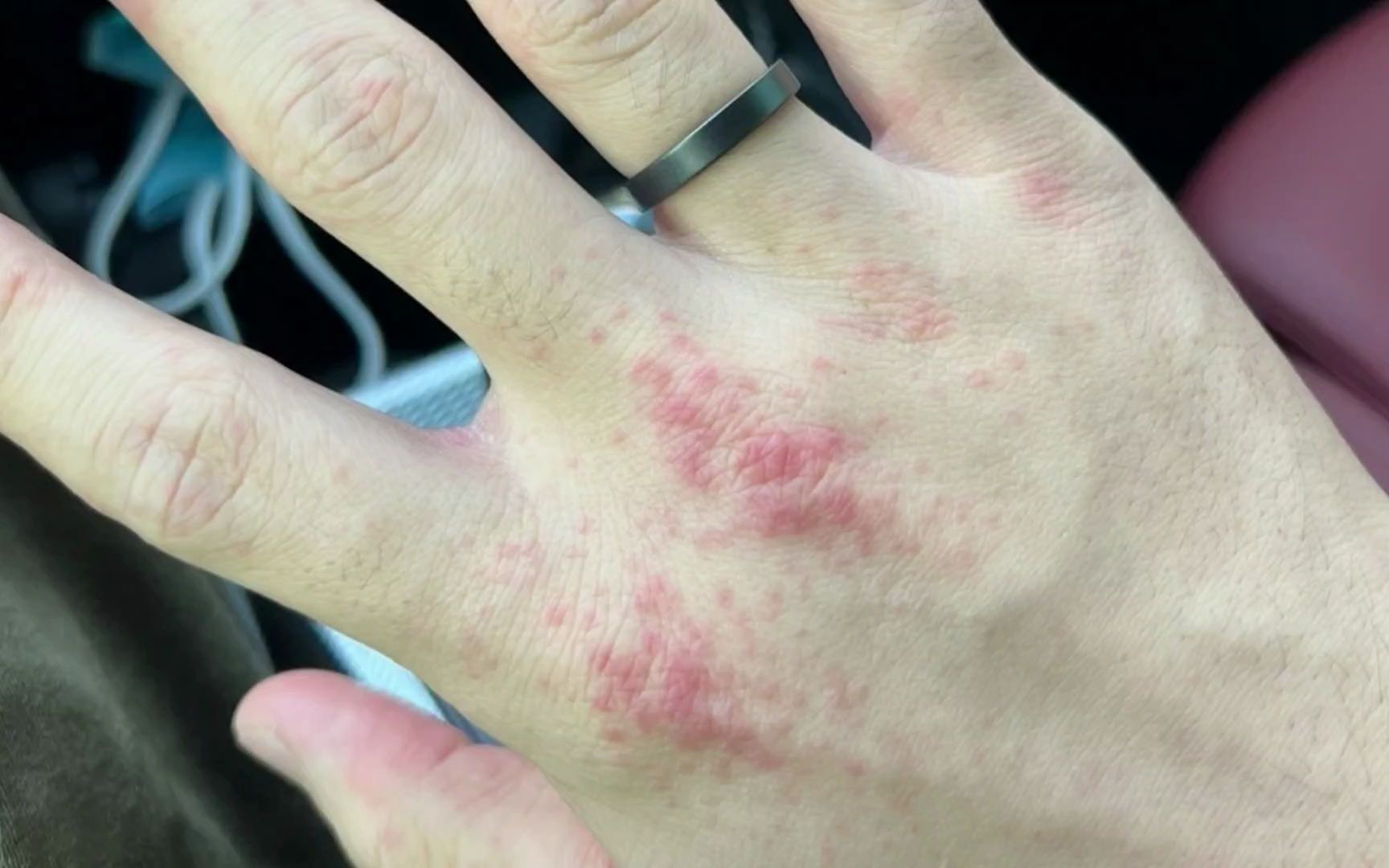 手上湿疹汗疱疹赶跑了,快乐回来了