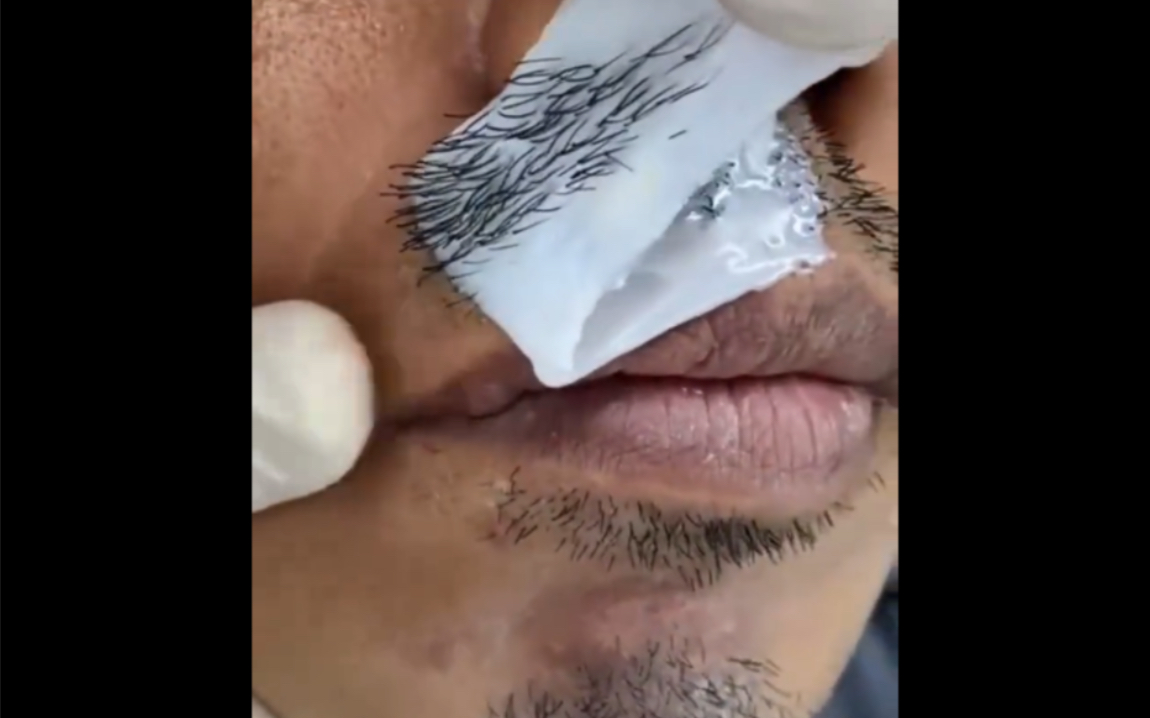 《解压实验室》:看缅北小哥哥 蜜蜡拔胡子,拔胡须,除毛毛!