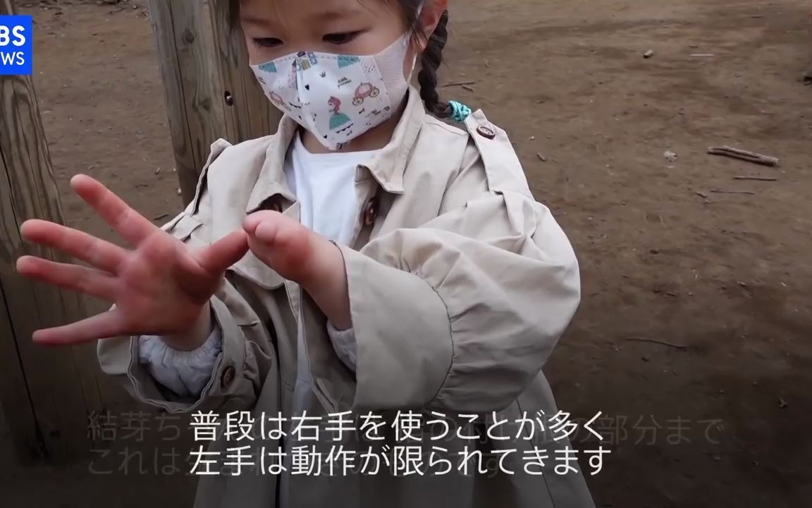 "一起运动吧"肌电假手辅助无手小女孩儿