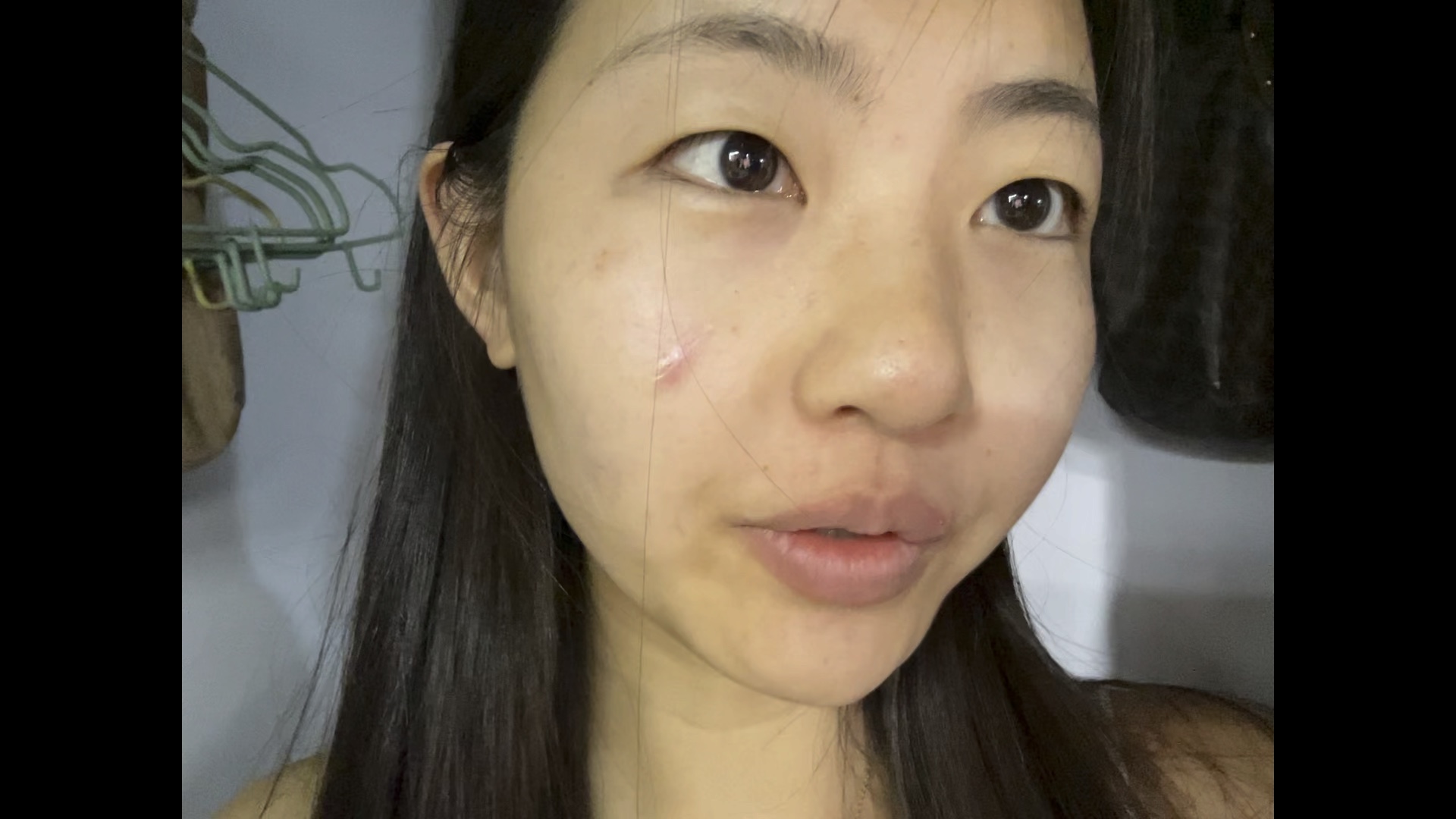 一点不吃的那种!#素颜 #凹陷瘢痕#切缝手术#精细美容缝合