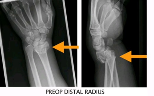 桡骨远端骨折,Distal Radius Fractures,点击下方字幕按钮,可以看到中文字幕哔哩哔哩bilibili