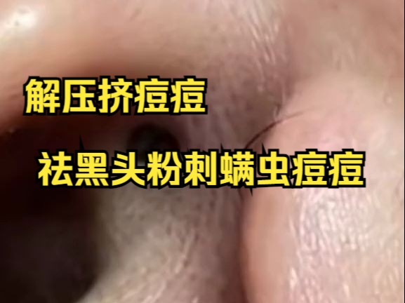 解压挤痘痘 祛黑头粉刺螨虫痘痘