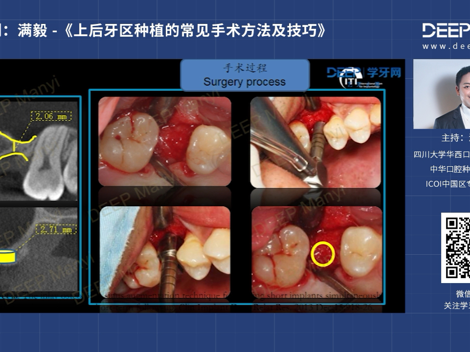 满毅《上后牙区种植的常见手术方法和技巧》哔哩哔哩bilibili