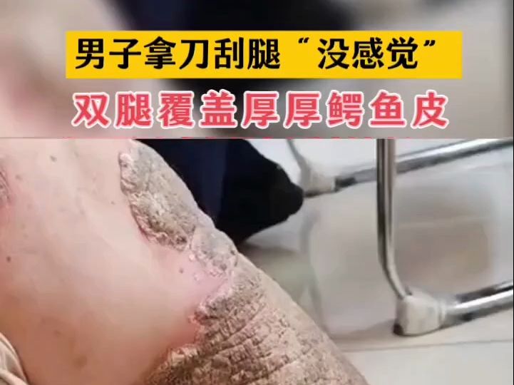 拿刀割腿没感觉,双腿不能走路