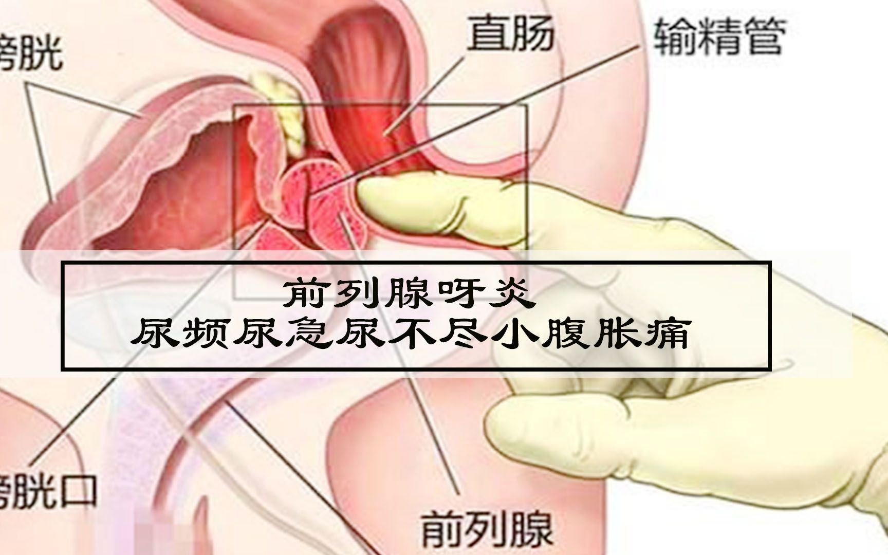 前列腺炎你哦阿频尿急尿不尽怎么治疗?哔哩哔哩bilibili