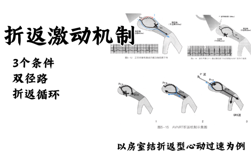 折返激动机制以AVNRT为例哔哩哔哩bilibili