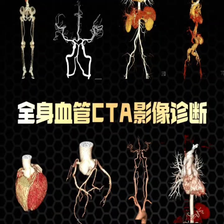 全身血管cta影像診斷肺支氣管動脈頭顱 臨床鼎湖影像學堂研究院