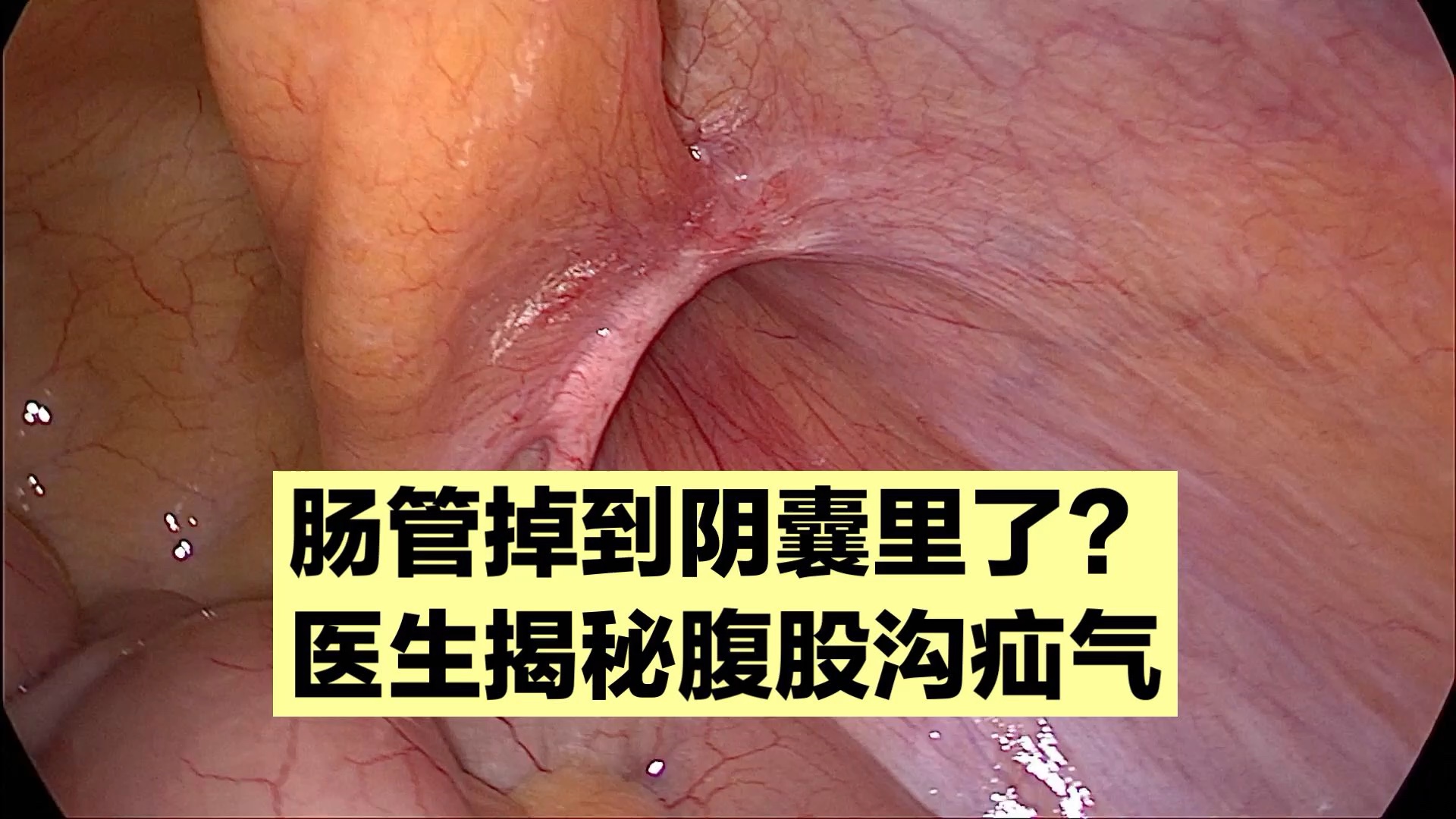 到底什么是腹股沟疝气?肠子怎么会从肚子里掉出来?这个视频告诉你答案哔哩哔哩bilibili