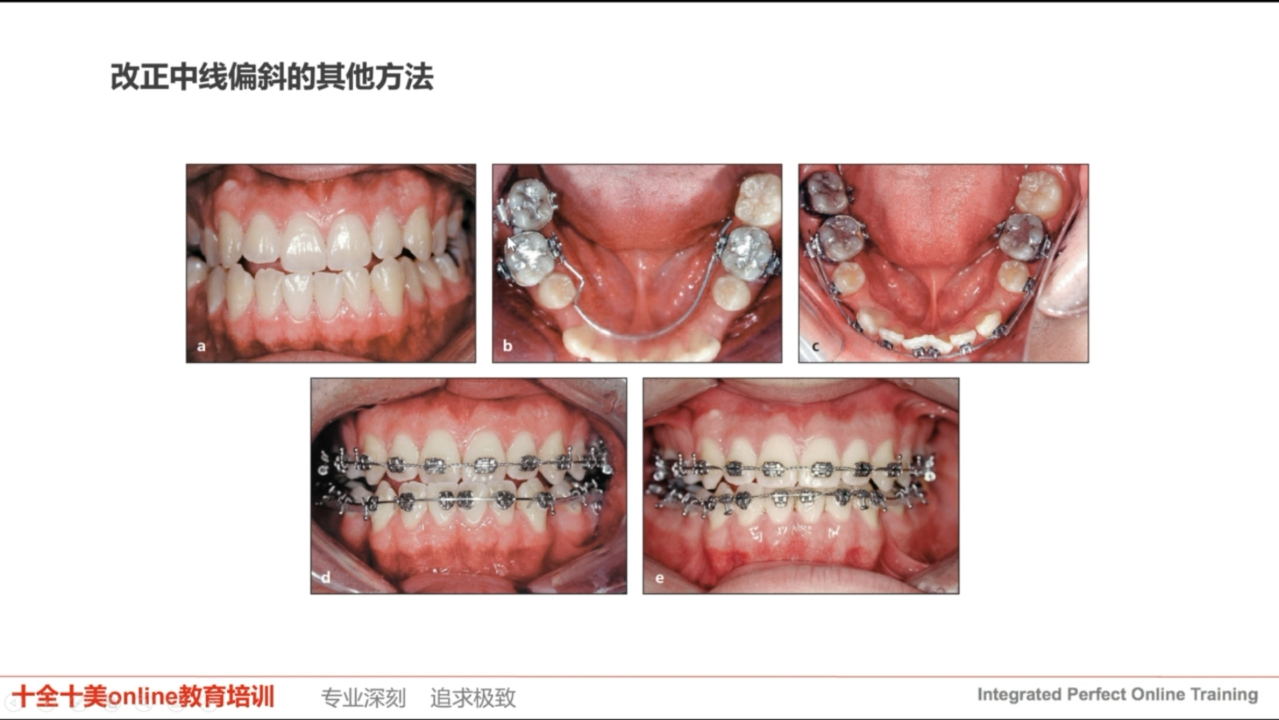 头帽口外弓 颌间牵引的创新用法讲师:沈韵哔哩哔哩bilibili