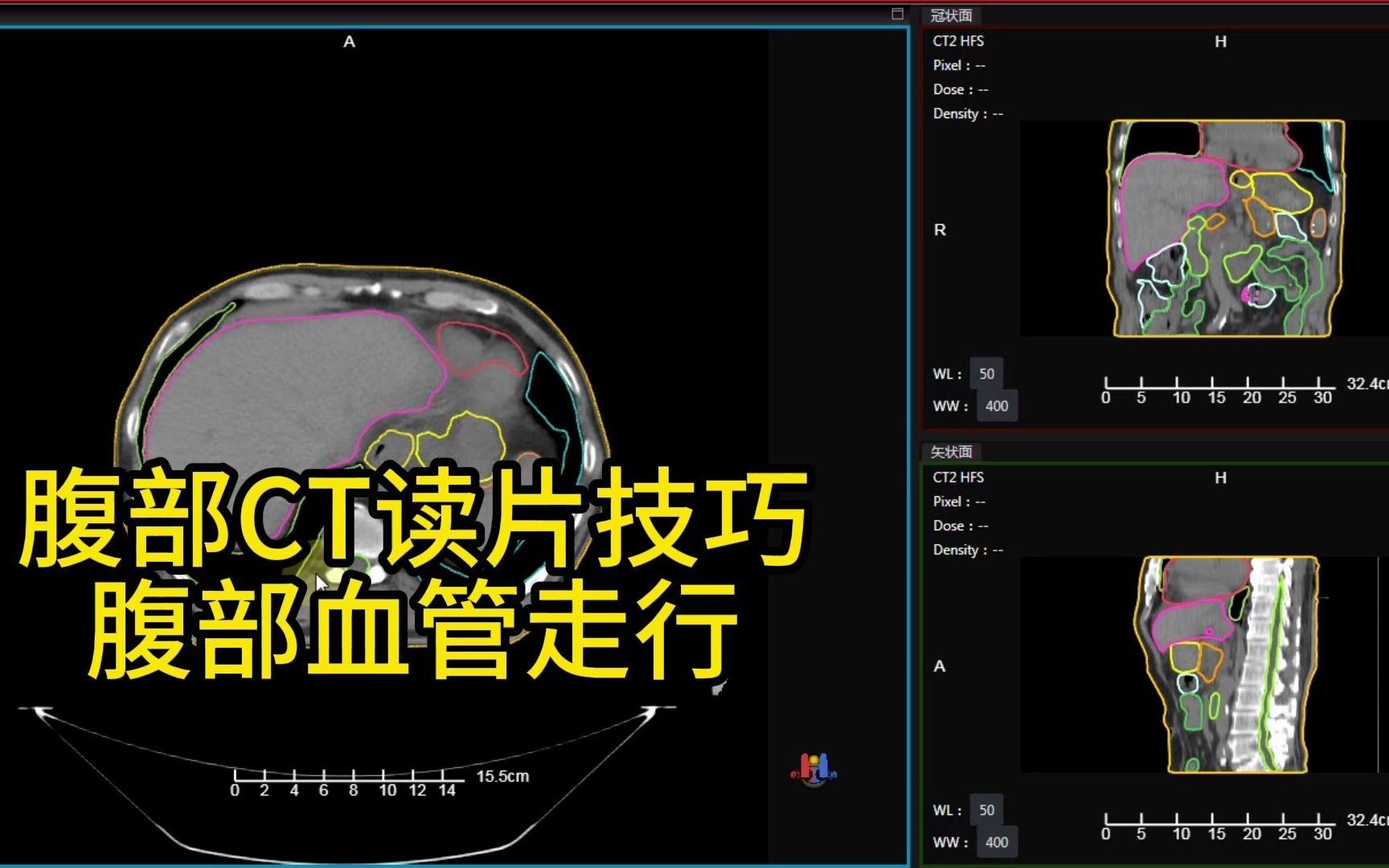 腹部CT读片技巧,腹部血管走行,腹部肠道走行!哔哩哔哩bilibili