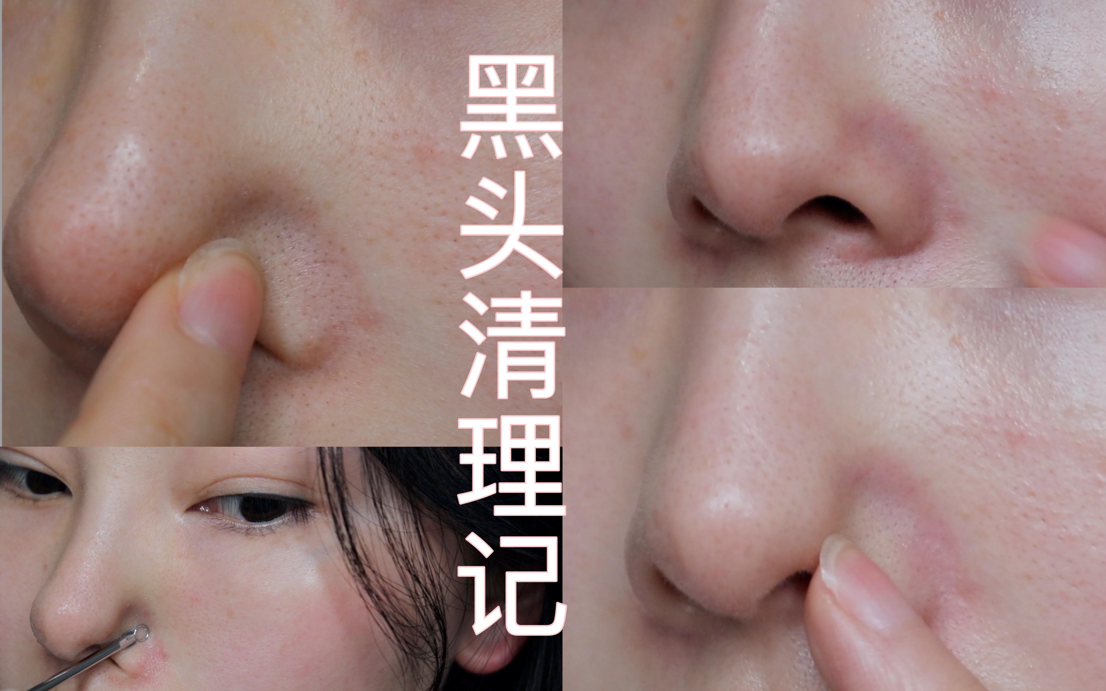 如何清理粉刺黑头受损后的肌肤该怎么修复跟我一起来解决黑头难题吧