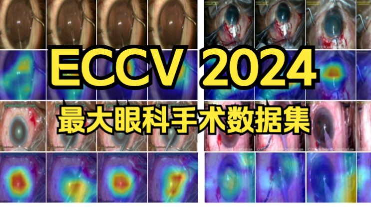 ECCV 2024 OphNet:最大规模和最细粒度的眼科手术视频理解数据集哔哩哔哩bilibili