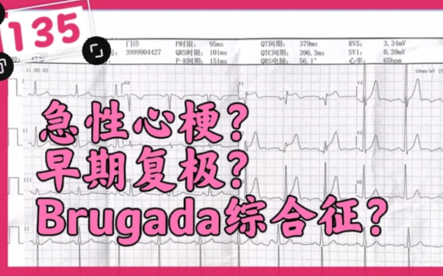 急性心梗,早期复极,Brugada综合征三者要注意区别哔哩哔哩bilibili