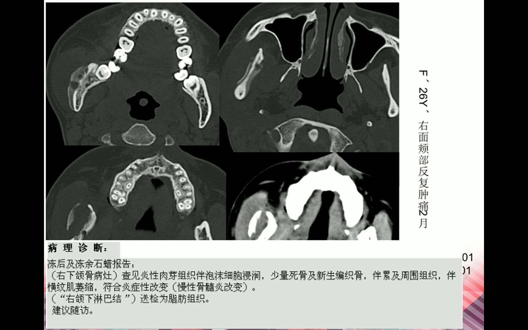 上下颌骨ct平扫解剖图片