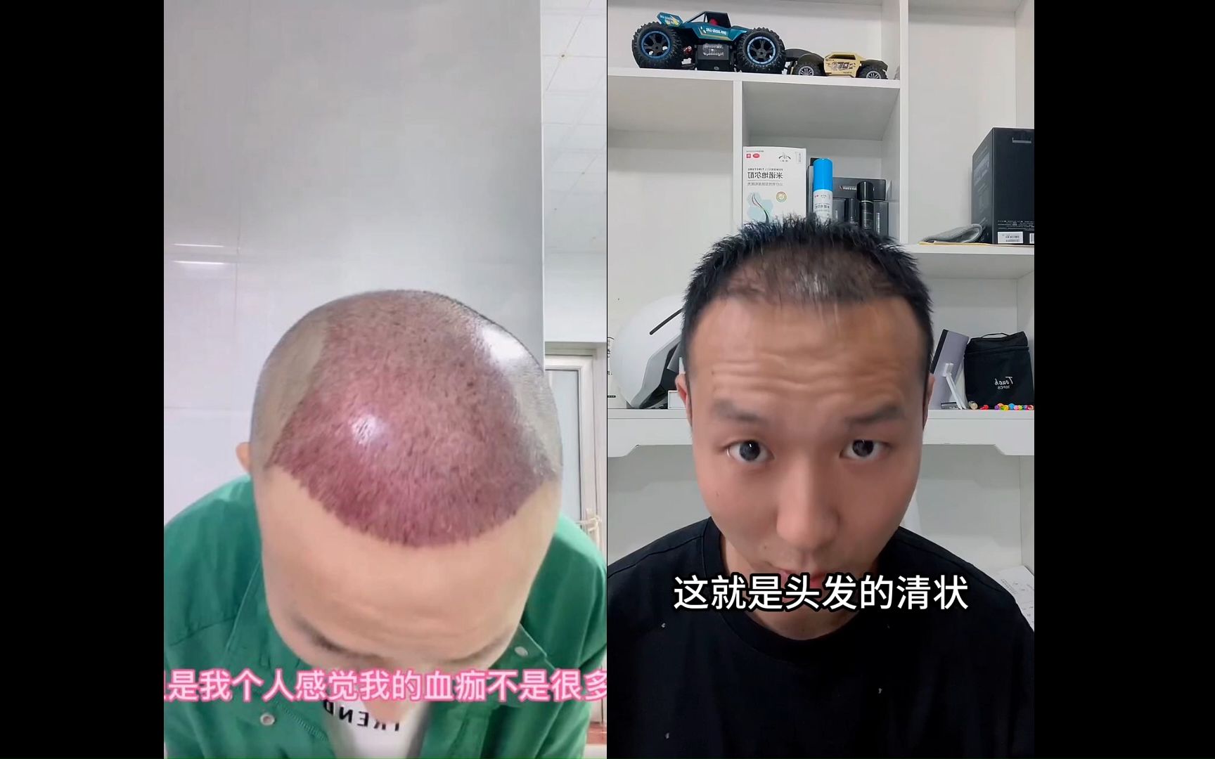 近距离观看植发5000单位效果,出现1000多很细小绒毛,坚持了100多天