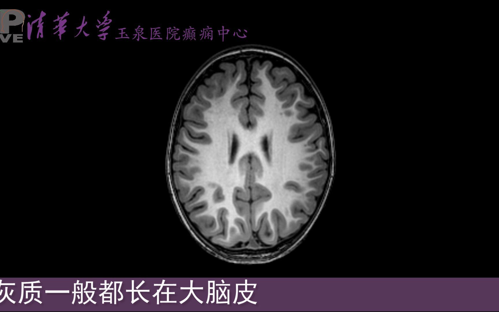 大脑的灰质是什么样子的?它会长到别的地方去吗?哔哩哔哩bilibili