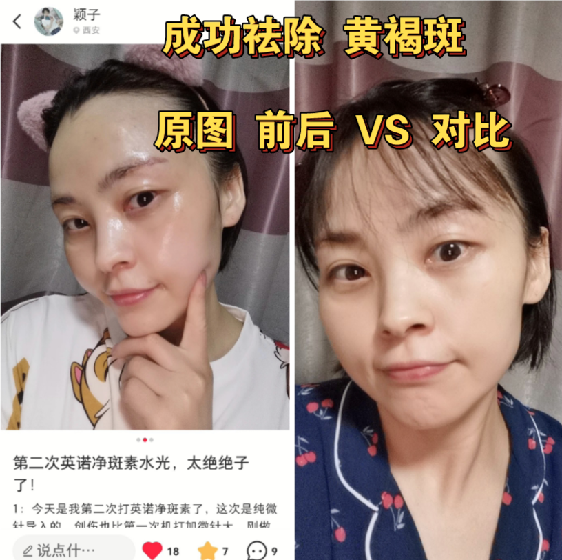 成功祛除 黄褐斑 素颜原图 前后 VS 对比哔哩哔哩bilibili