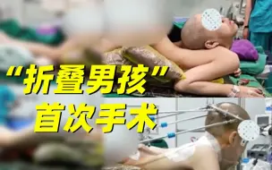 一次性矫正至少90度！“折叠男孩”首次手术超预期