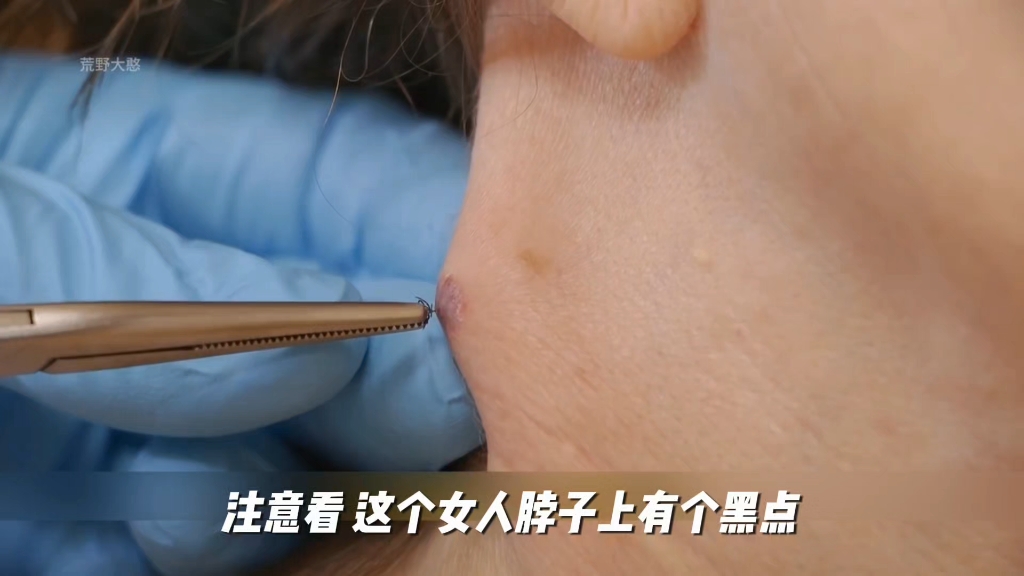 蜱虫寄生人类皮肤