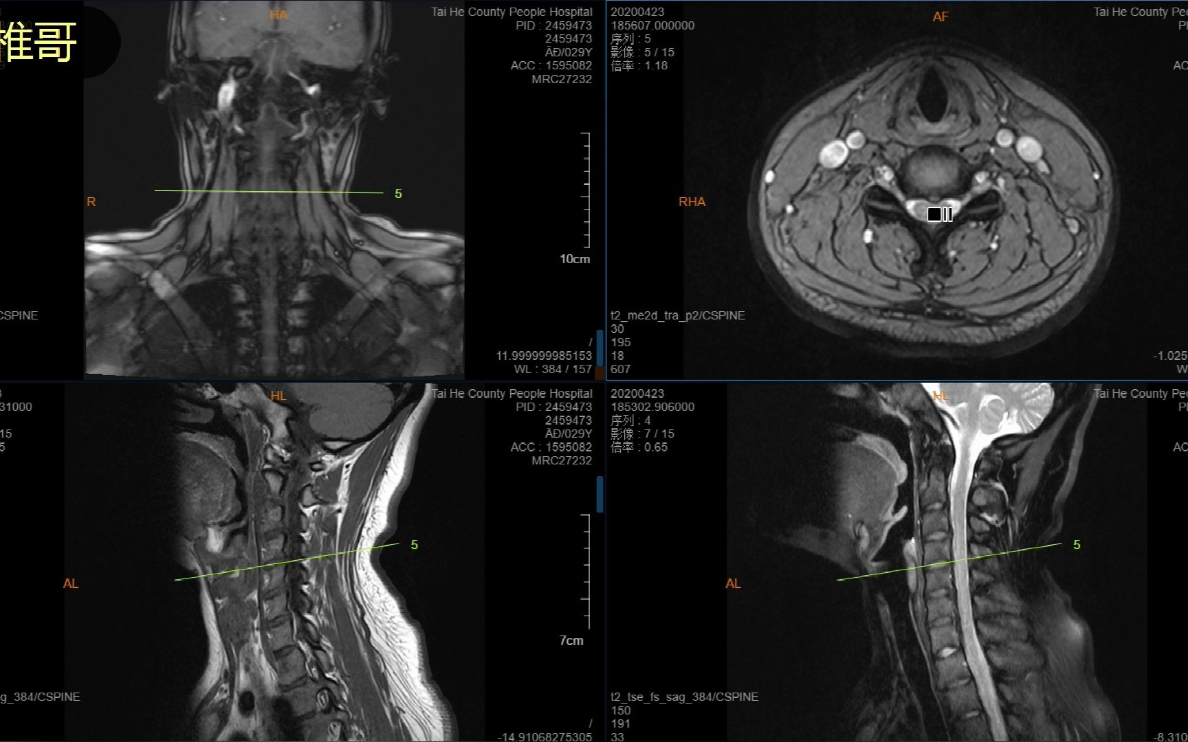 颈椎核磁图谱解析图片