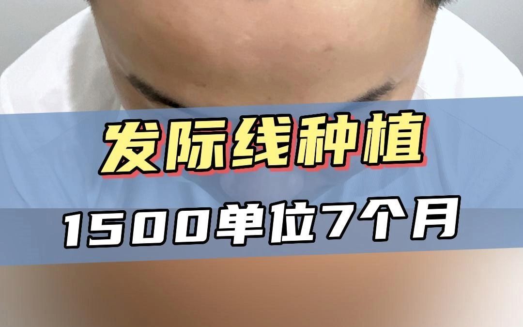 FUE提取技术有哪些优点?男生发际线种植1500毛囊单位7个月分享哔哩哔哩bilibili