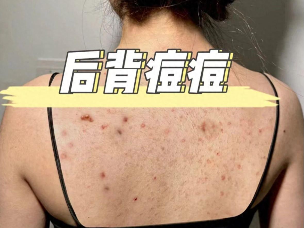 后背痘痘泛滥、瘙痒,一定要先除螨!过来人教你轻松告别螨虫痘!哔哩哔哩bilibili