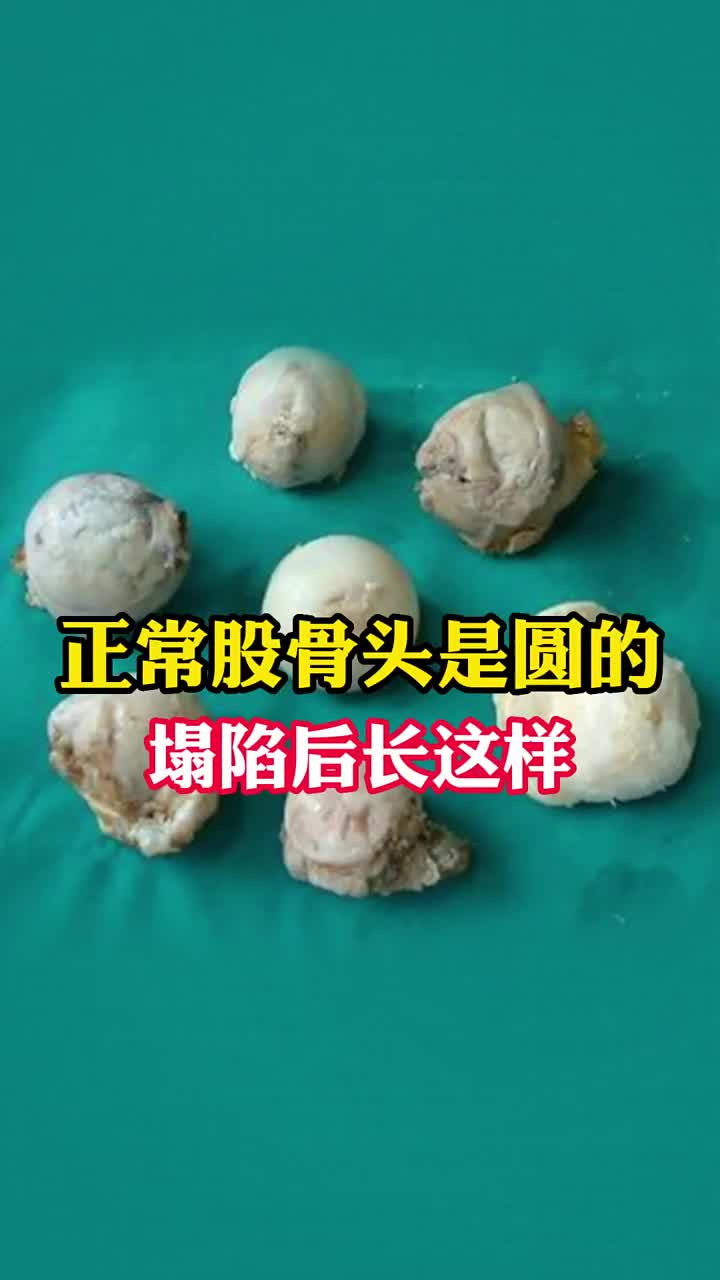 股骨头坏死塌陷后的样子,你见过吗?哔哩哔哩bilibili