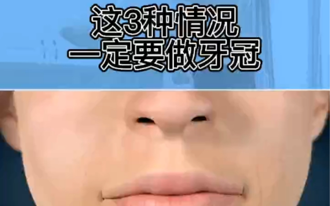 这三种情况一定要做牙冠哔哩哔哩bilibili