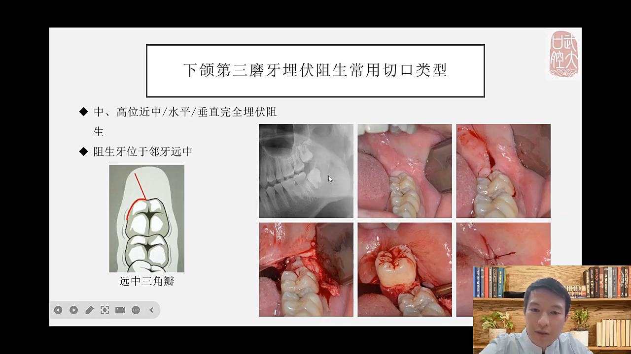 周小程最值得看的一堂课——24武大口腔小手术哔哩哔哩bilibili