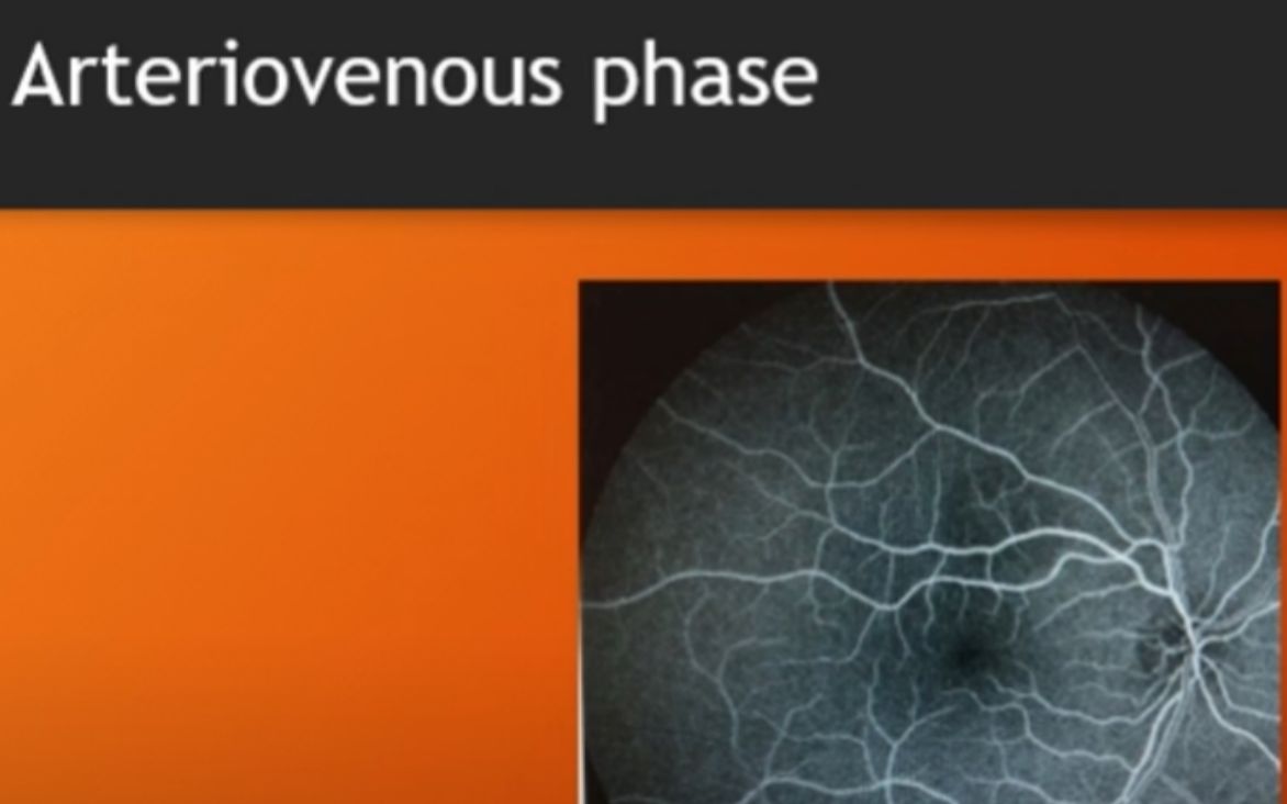 [图]【中英双字】【FFA眼底荧光素血管造影】Fluorescein angiography FFA Dye test in eyes