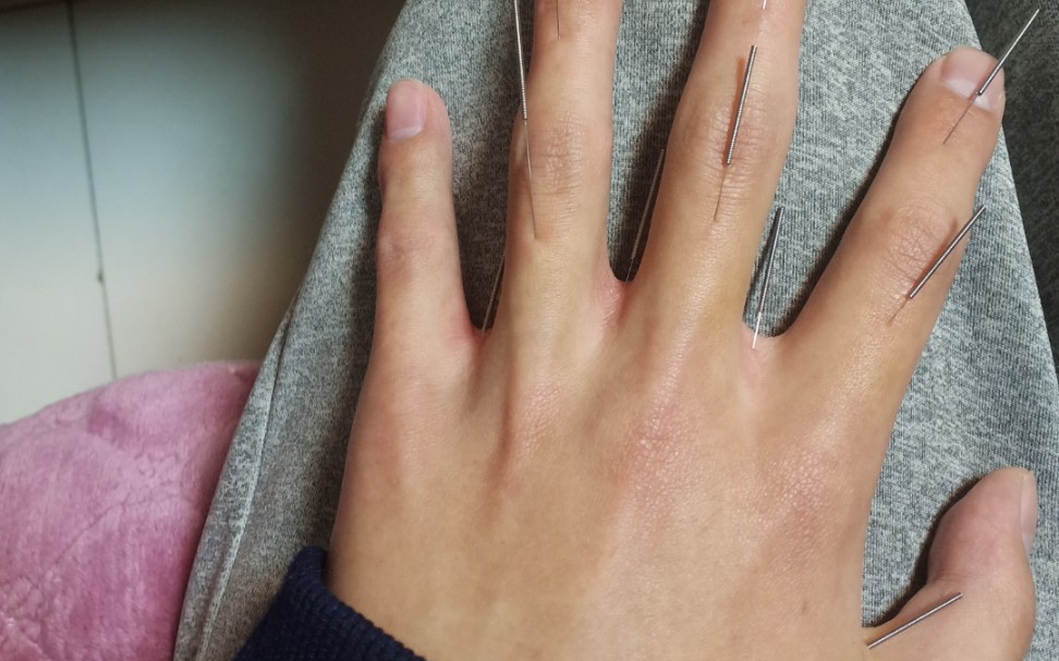 针灸起针(有点疼)