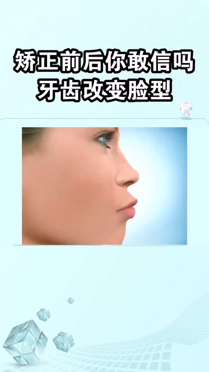 矫正牙齿对脸型的前后改变看完你可能不相信自己的眼睛大连齿医生口腔