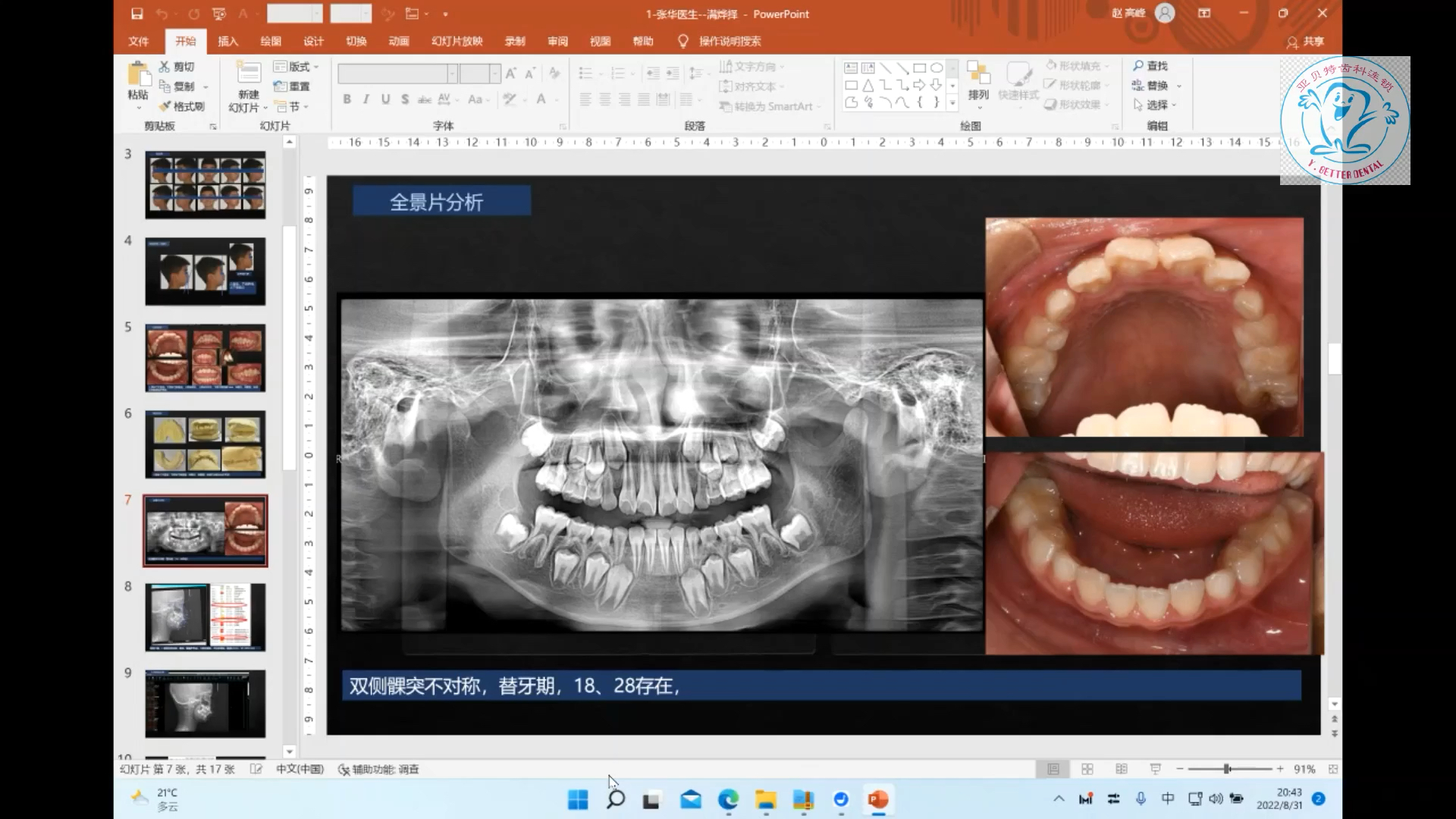 跟着病例学正畸3——赵高峰哔哩哔哩bilibili