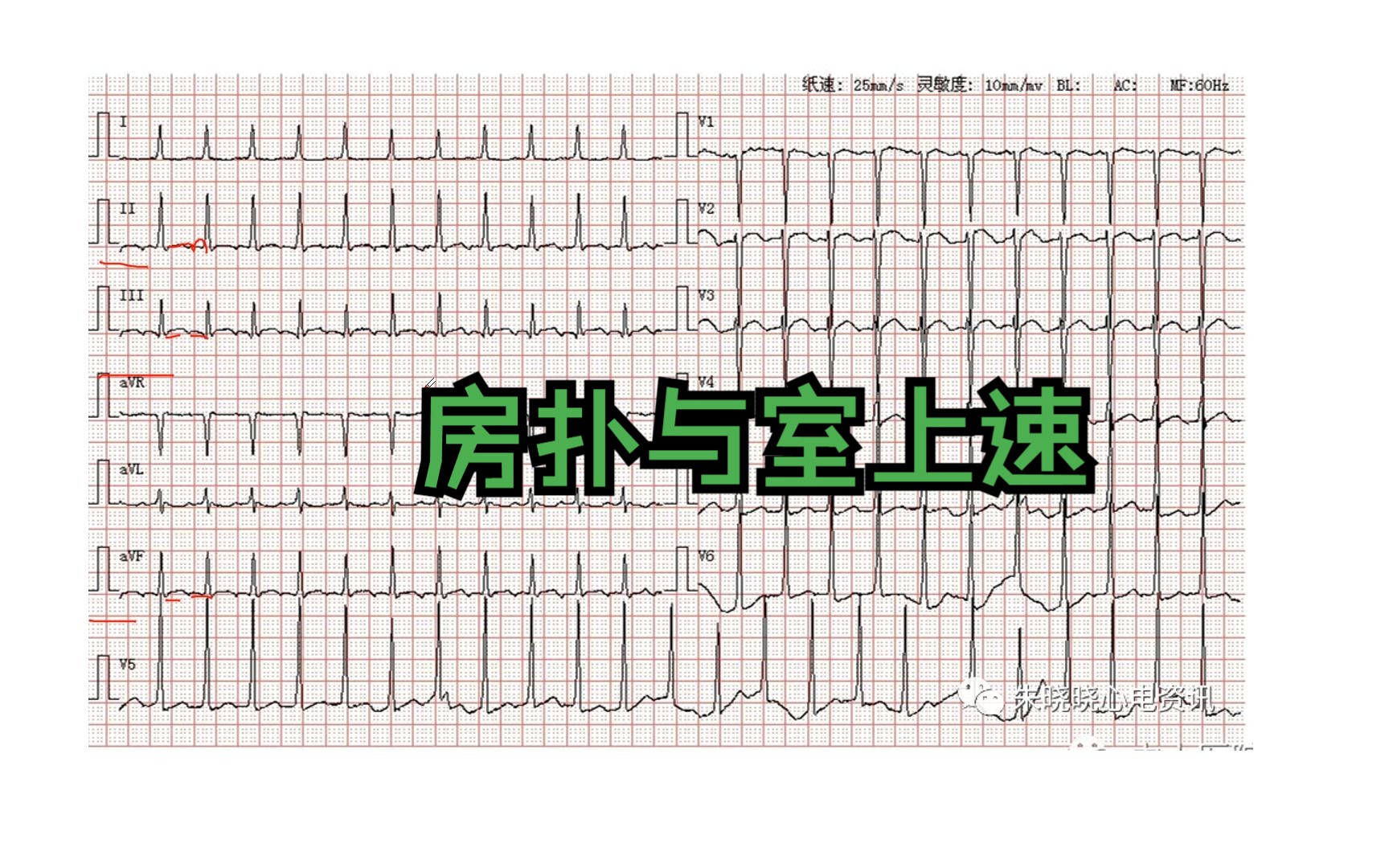 【心电图学习4】 | 房扑与室上速的鉴别哔哩哔哩bilibili