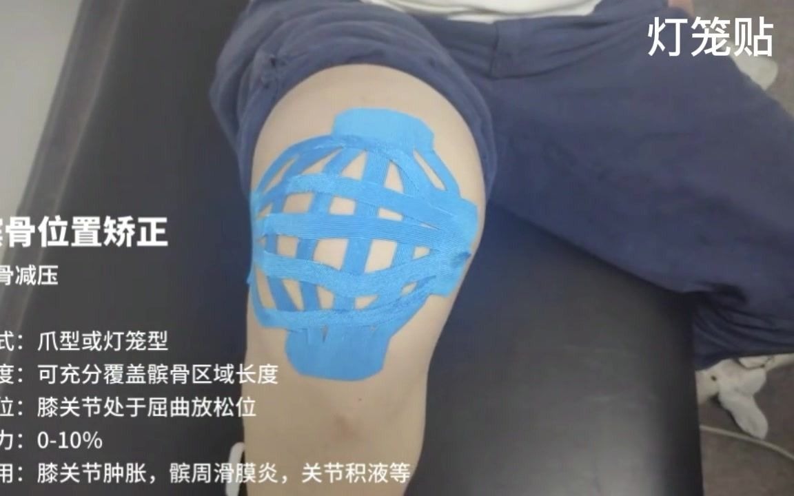 RSHealth宣教肌贴膝关节滑膜炎及肿胀哔哩哔哩bilibili